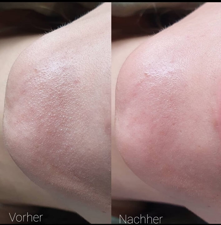 Hydra Facial vorher nacher glamcosmetic
