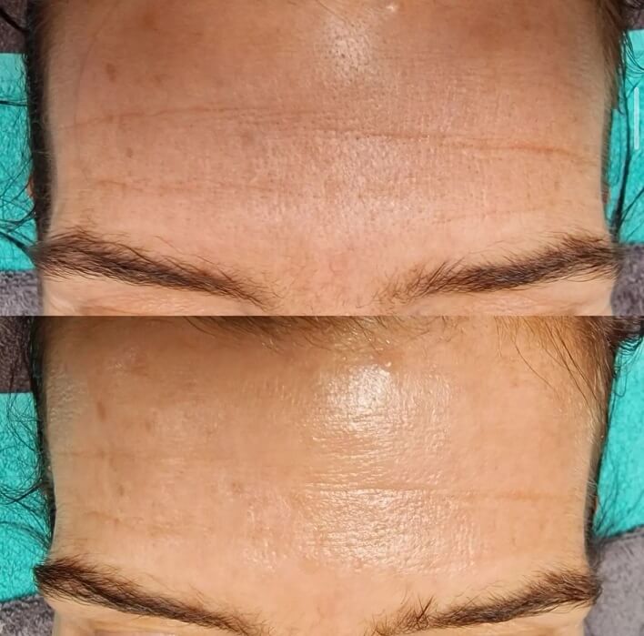 Hydra Facial vorher nacher glamcosmetic 2