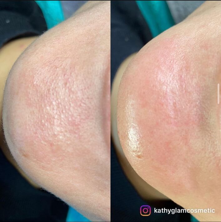 Hydra Facial vorher nacher glamcosmetic 3