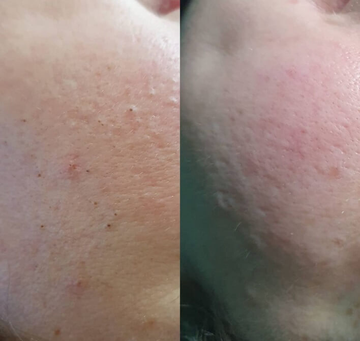 Hydra Facial vorher nacher glamcosmetic 4