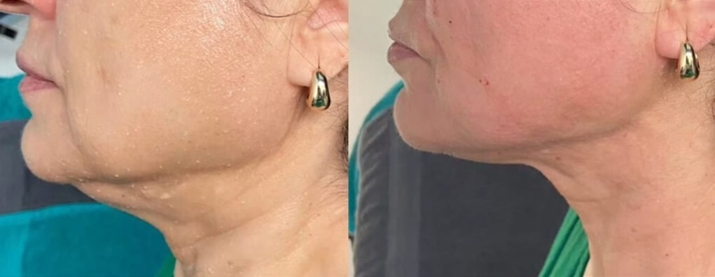 Morpheus 8 Glamcosmetic vorher nacher 3(2)