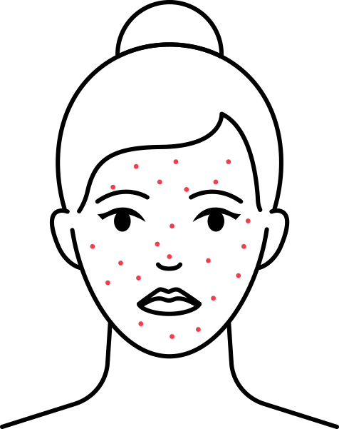 Akne Kosmetikbehandlung GLAMcosmetic Olten